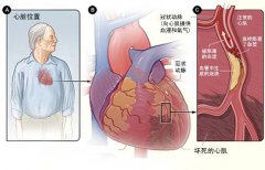 冠心病的起因是什么？