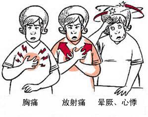冠心病有哪些癥狀？(圖1)