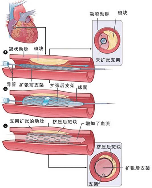怎樣治療冠心??？(圖2)