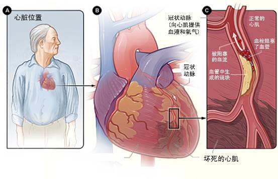 怎樣治療冠心??？(圖3)