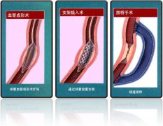 怎樣治療冠心??？