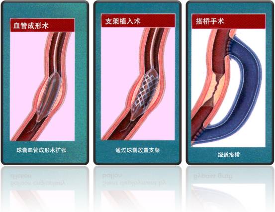 怎樣治療冠心?。?圖1)
